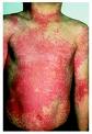 Scarlet Fever rash