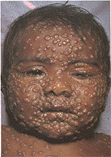 A victim of smallpox